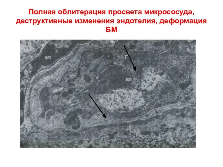 Полная облитерация просвета микрососуда, деструктивные изменения эндотелия, деформация БМ