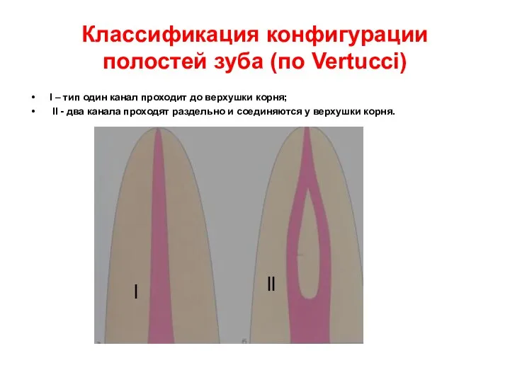 Классификация конфигурации полостей зуба (по Vertucci) l – тип один канал