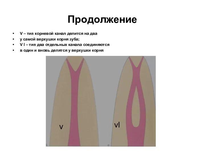 Продолжение V – тип корневой канал делится на два у самой