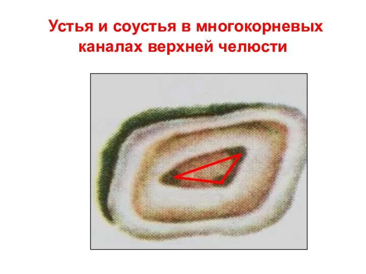 Устья и соустья в многокорневых каналах верхней челюсти