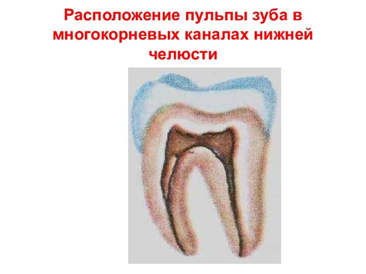 Расположение пульпы зуба в многокорневых каналах нижней челюсти