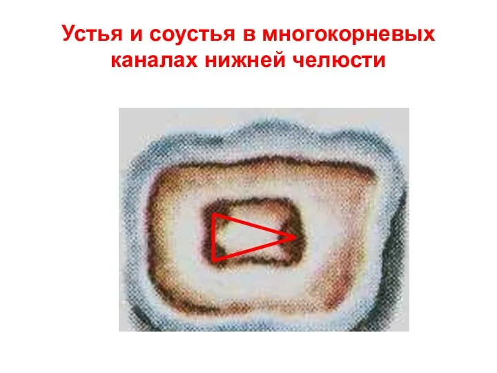 Устья и соустья в многокорневых каналах нижней челюсти