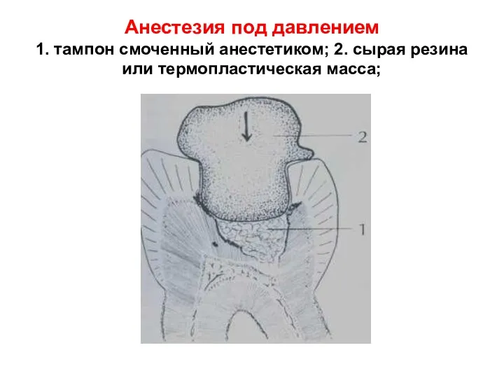 Анестезия под давлением 1. тампон смоченный анестетиком; 2. сырая резина или термопластическая масса;