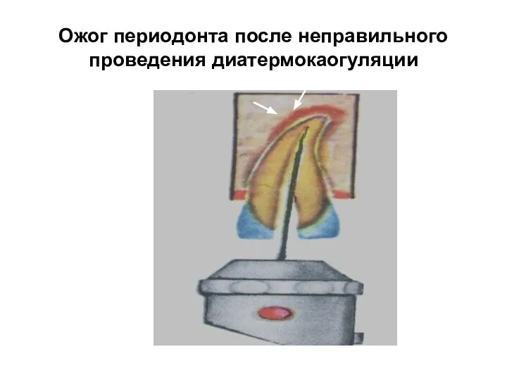 Ожог периодонта после неправильного проведения диатермокаогуляции