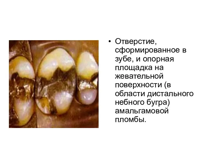 Отверстие, сформированное в зубе, и опорная площадка на жевательной поверхности (в
