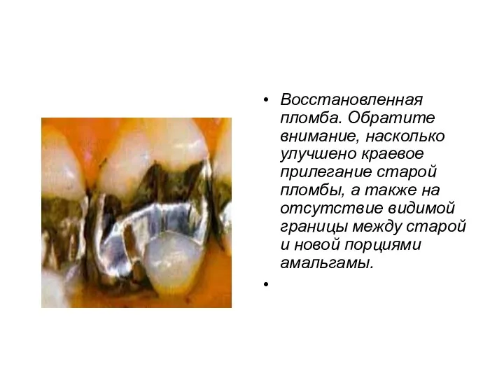 Восстановленная пломба. Обратите внимание, насколько улучшено краевое прилегание старой пломбы, а