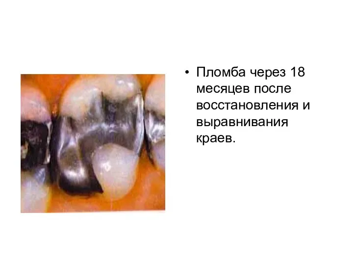 Пломба через 18 месяцев после восстановления и выравнивания краев.