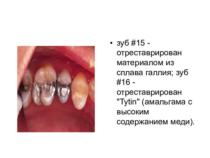 зуб #15 - отреставрирован материалом из сплава галлия; зуб #16 -