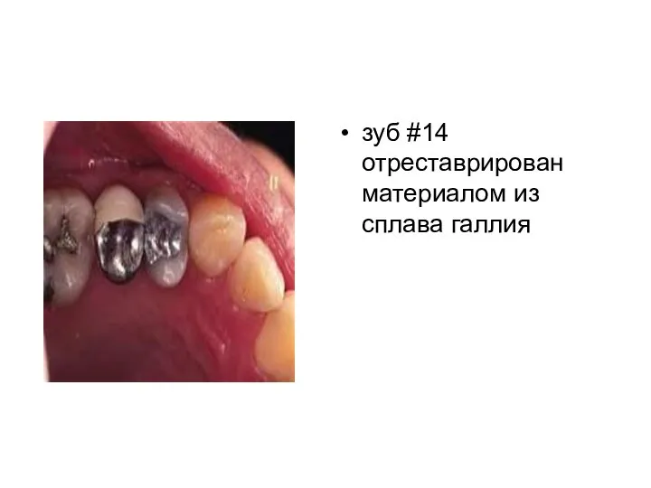 зуб #14 отреставрирован материалом из сплава галлия