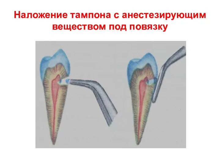 Наложение тампона с анестезирующим веществом под повязку