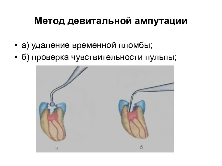 Метод девитальной ампутации а) удаление временной пломбы; б) проверка чувствительности пульпы;