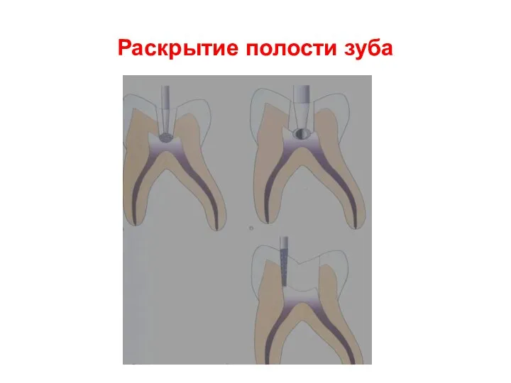 Раскрытие полости зуба