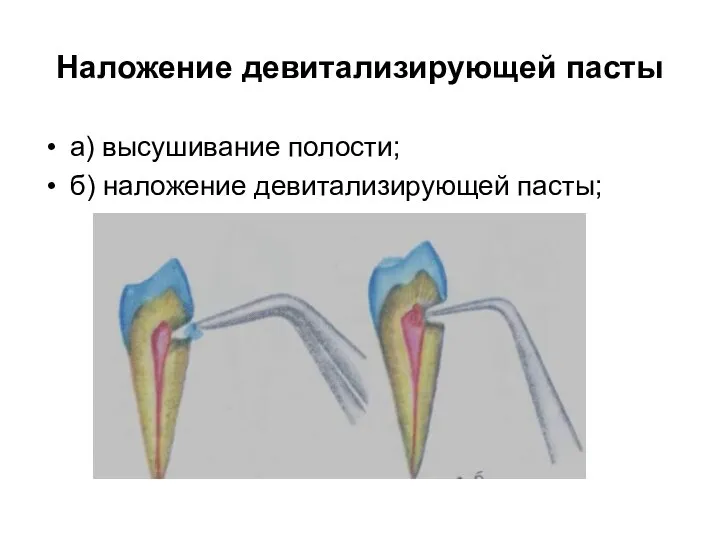 Наложение девитализирующей пасты а) высушивание полости; б) наложение девитализирующей пасты;