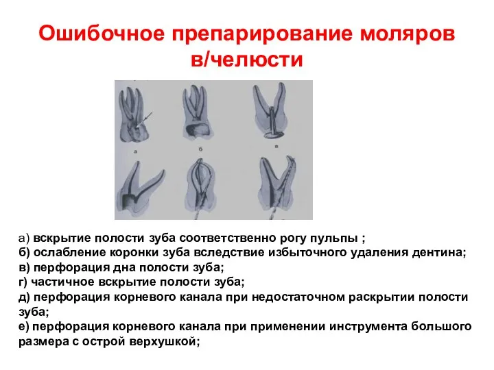 Ошибочное препарирование моляров в/челюсти а) вскрытие полости зуба соответственно рогу пульпы