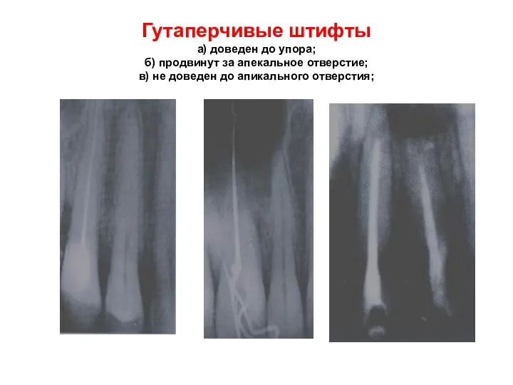 Гутаперчивые штифты а) доведен до упора; б) продвинут за апекальное отверстие;