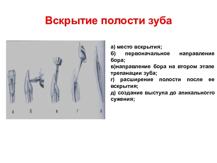 Вскрытие полости зуба а) место вскрытия; б) первоначальное направление бора; в)направление