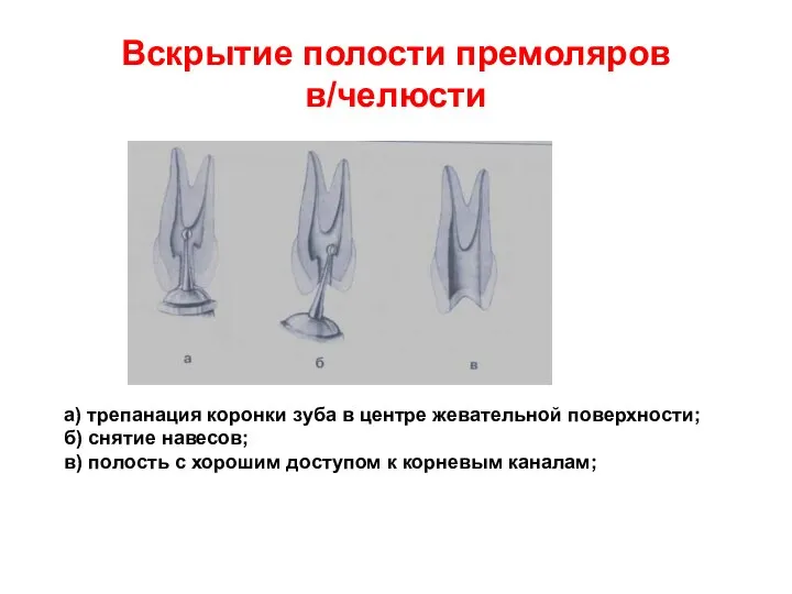 Вскрытие полости премоляров в/челюсти а) трепанация коронки зуба в центре жевательной