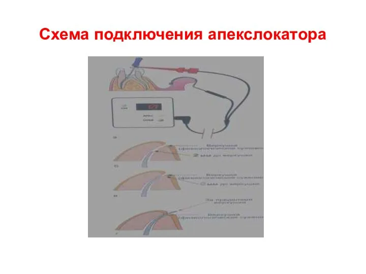 Схема подключения апекслокатора