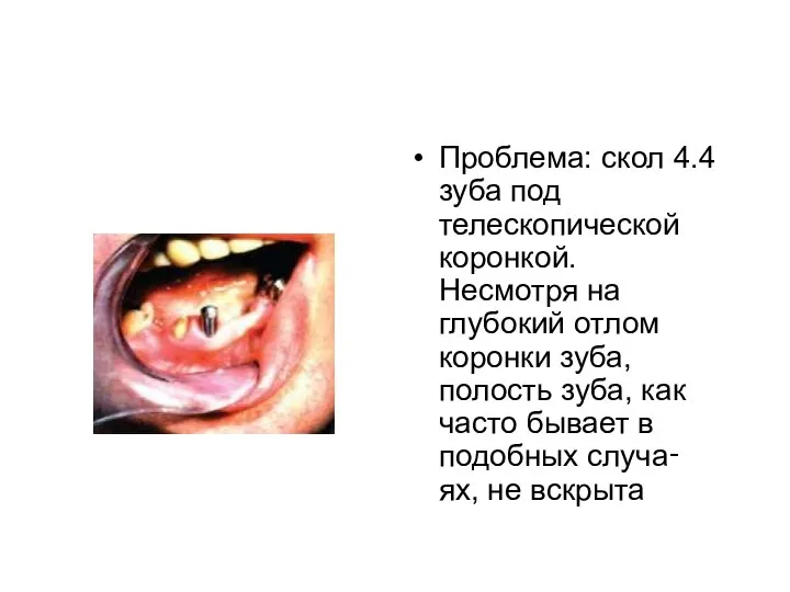 Проблема: скол 4.4 зуба под телескопической коронкой. Несмотря на глубокий отлом