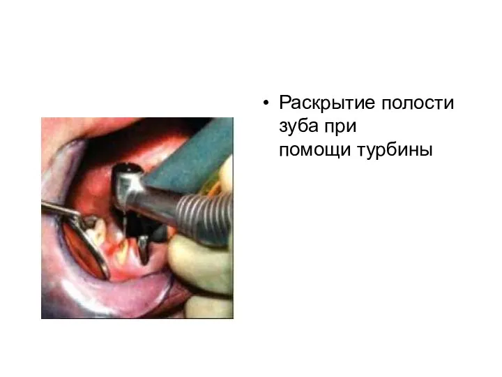 Раскрытие полости зуба при помощи турбины
