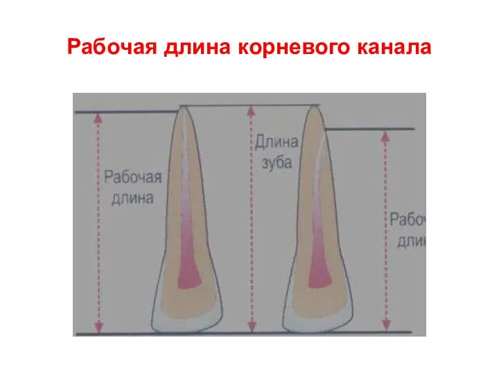 Рабочая длина корневого канала