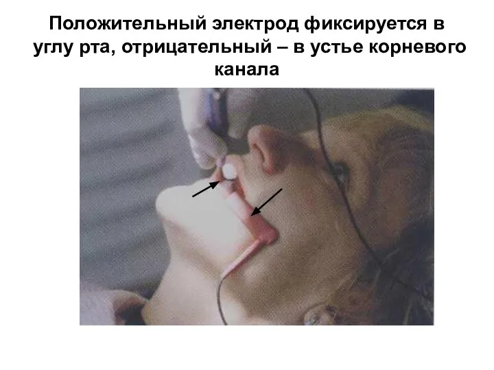 Положительный электрод фиксируется в углу рта, отрицательный – в устье корневого канала