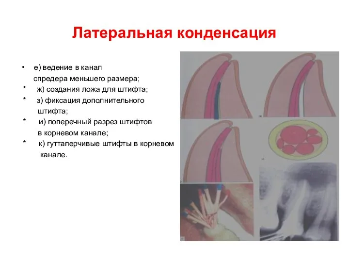 Латеральная конденсация е) ведение в канал спредера меньшего размера; * ж)