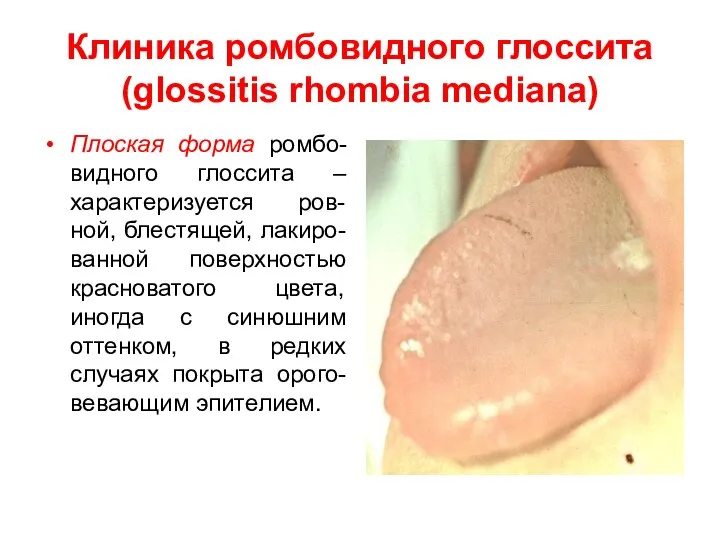 Клиника ромбовидного глоссита (glossitis rhombia mediana) Плоская форма ромбо-видного глоссита –