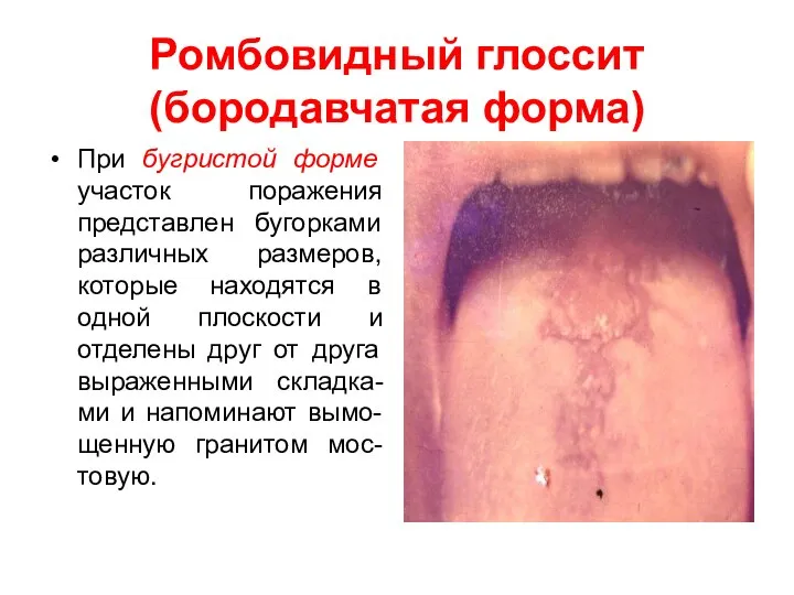 Ромбовидный глоссит (бородавчатая форма) При бугристой форме участок поражения представлен бугорками