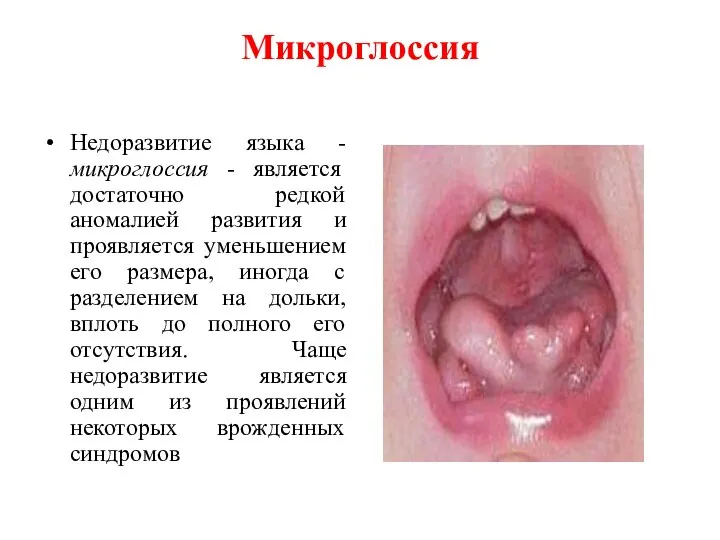 Микроглоссия Недоразвитие языка - микроглоссия - является достаточно редкой аномалией развития
