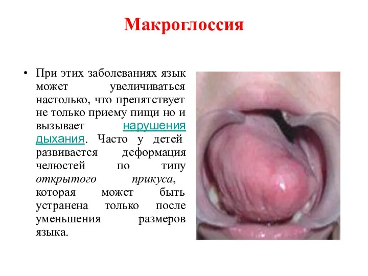 Макроглоссия При этих заболеваниях язык может увеличиваться настолько, что препятствует не