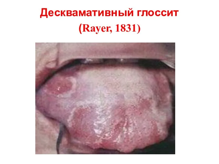 Десквамативный глоссит (Rayer, 1831)