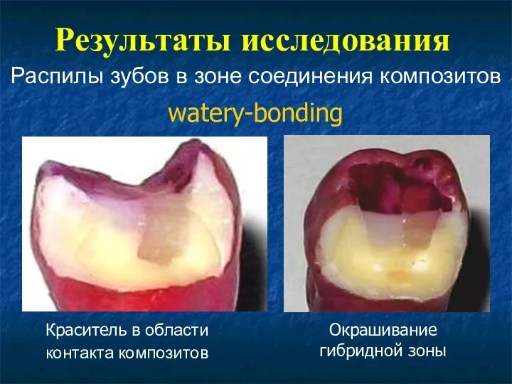 Результаты исследования Распилы зубов в зоне соединения композитов Краситель в области