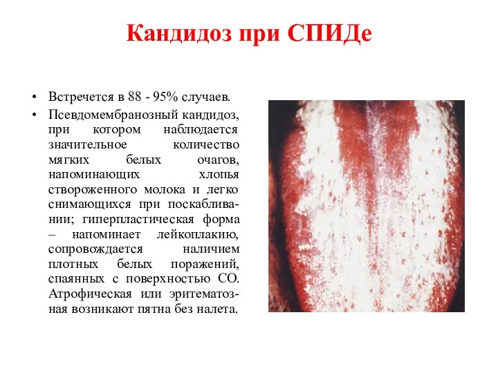 Кандидоз при СПИДе Встречется в 88 - 95% случаев. Псевдомембранозный кандидоз,