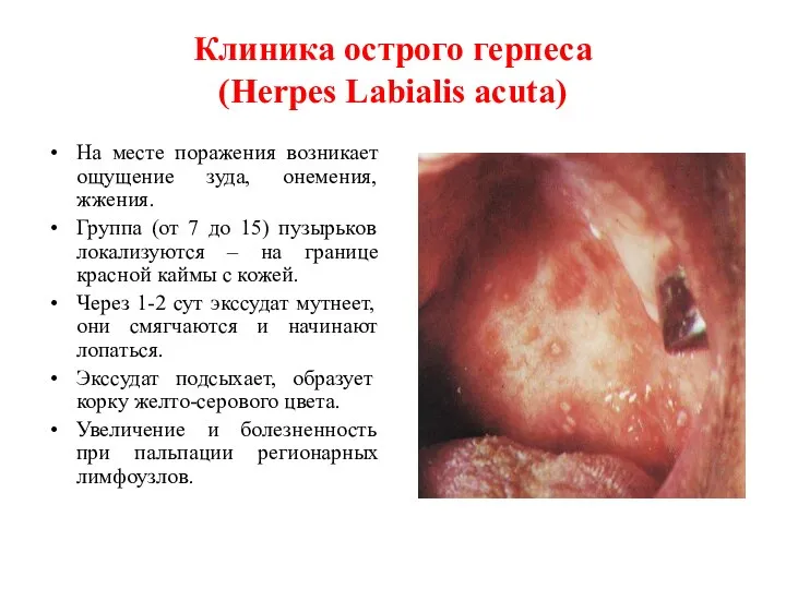 Клиника острого герпеса (Herpes Labialis acuta) На месте поражения возникает ощущение