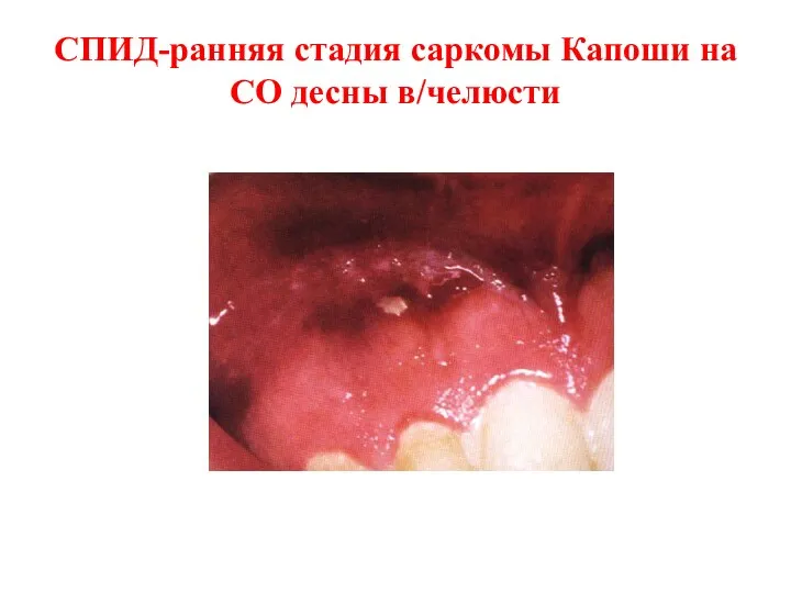 СПИД-ранняя стадия саркомы Капоши на СО десны в/челюсти