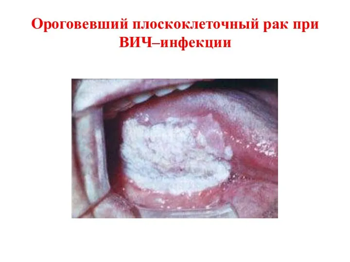 Ороговевший плоскоклеточный рак при ВИЧ–инфекции