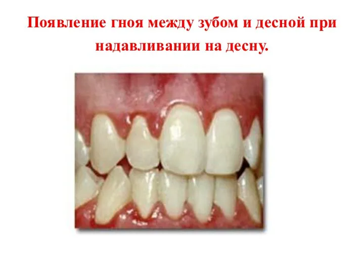 Появление гноя между зубом и десной при надавливании на десну.