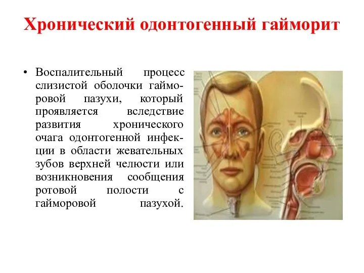 Хронический одонтогенный гайморит Воспалительный процесс слизистой оболочки гаймо-ровой пазухи, который проявляется