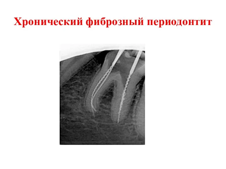 Хронический фиброзный периодонтит