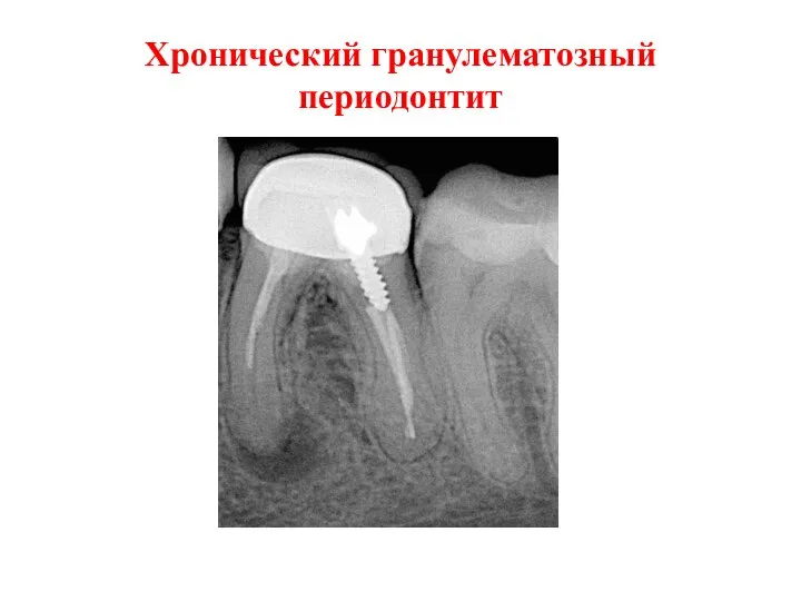 Хронический гранулематозный периодонтит