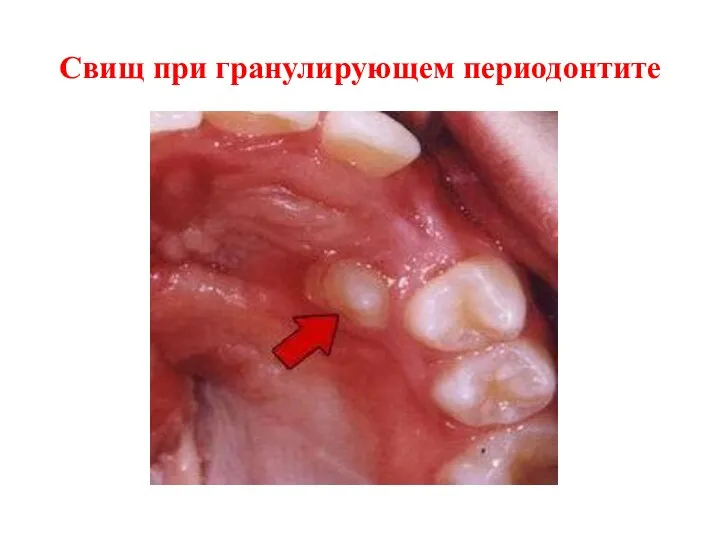 Свищ при гранулирующем периодонтите