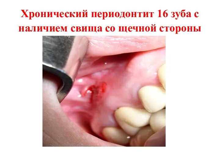 Хронический периодонтит 16 зуба с наличием свища со щечной стороны