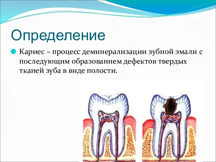 Определение Кариес – процесс деминерализации зубной эмали с последующим образованием дефектов