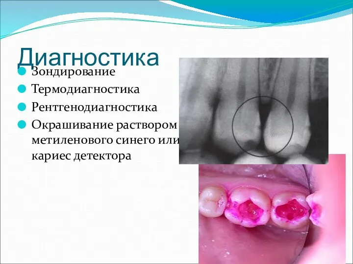 Диагностика Зондирование Термодиагностика Рентгенодиагностика Окрашивание раствором метиленового синего или кариес детектора