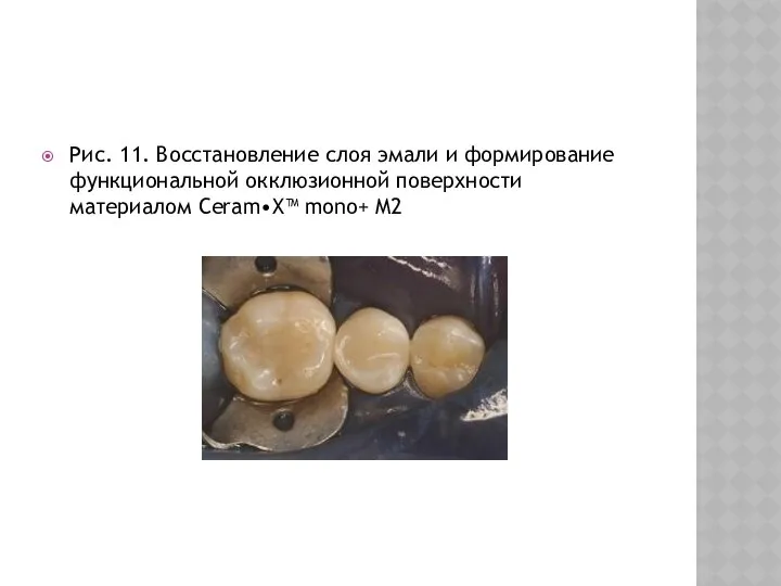 Рис. 11. Восстановление слоя эмали и формирование функциональной окклюзионной поверхности материалом Ceram•X™ mono+ M2