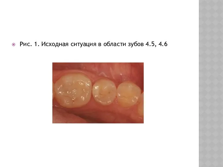 Рис. 1. Исходная ситуация в области зубов 4.5, 4.6