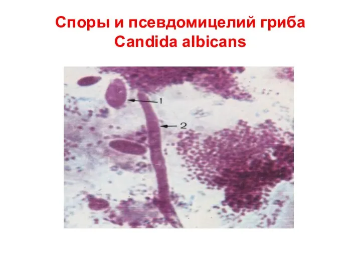 Споры и псевдомицелий гриба Candida albicans