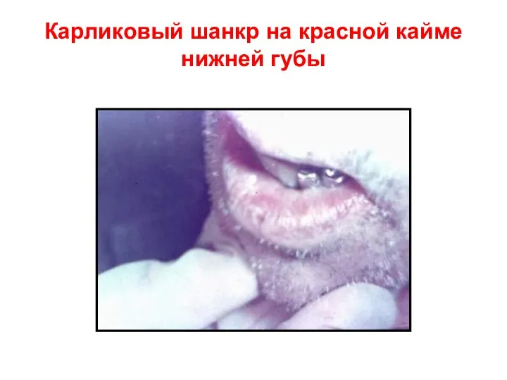 Карликовый шанкр на красной кайме нижней губы