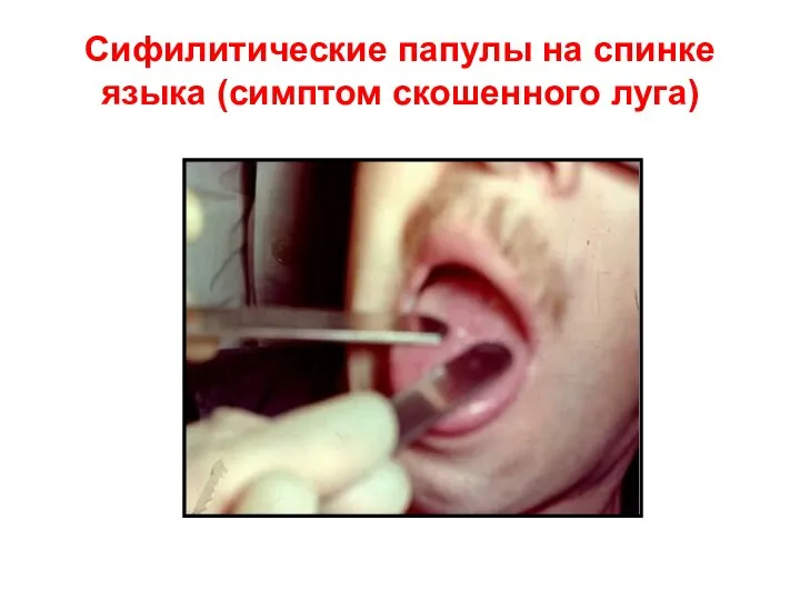 Сифилитические папулы на спинке языка (симптом скошенного луга)